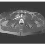 Resonancia Magnética de Sínfisis del Pubis